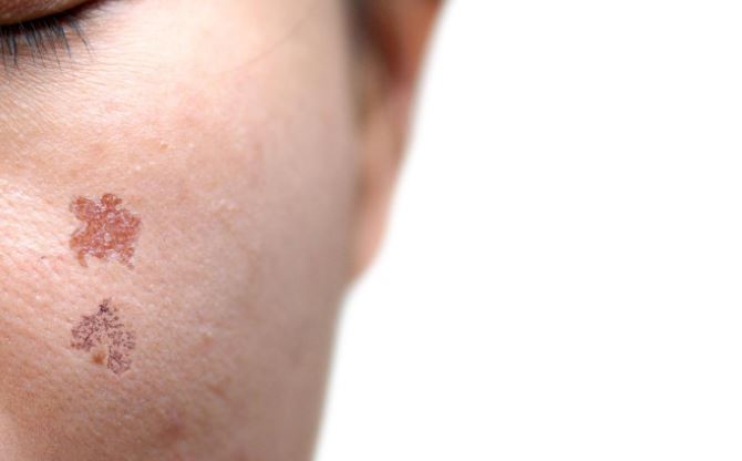 Hình ảnh tổn thương sau làm Laser Fractional CO2
