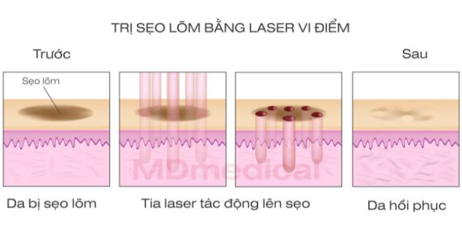 trị sẹo lõm bằng laser vi điểm