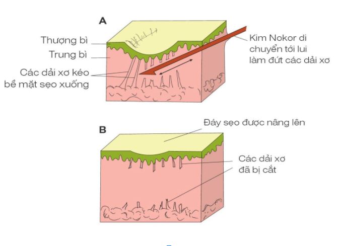 Trị sẹo lõm bằng thủ thuật bóc tách đáy sẹo
