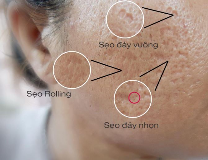 phân loại sẹo
