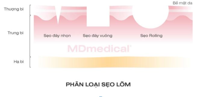 phân loại sẹo lõm