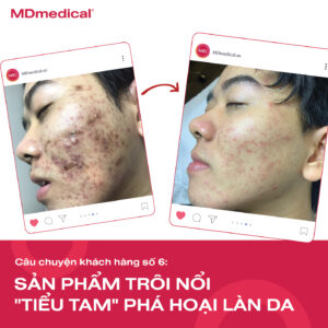 hiệu quả điều trị mụn 90%