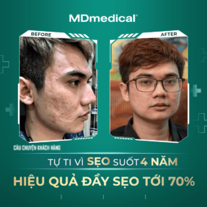 Làm đầy đáy sẹo lên tới 80%