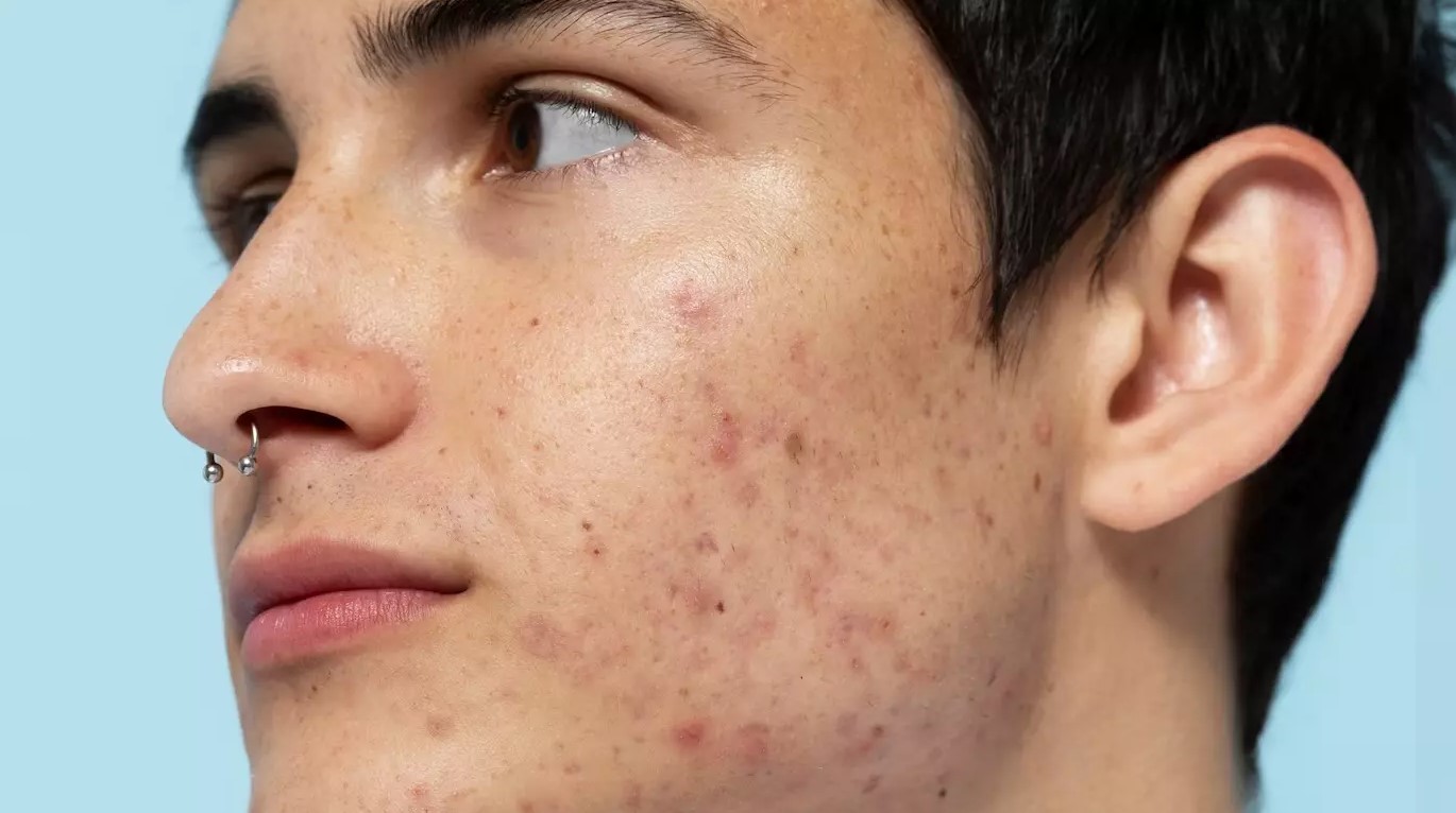 cách điều trị mụn trứng cá