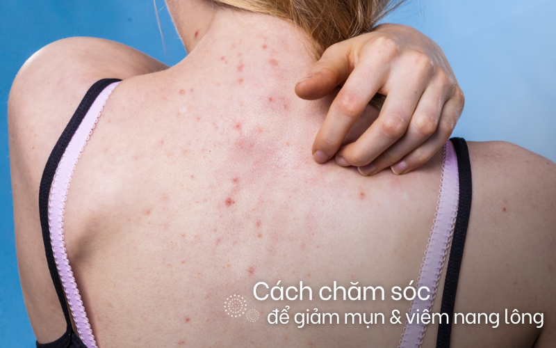 Cách chăm sóc để giảm mụn cơ thể và viêm nang lông mùa nóng