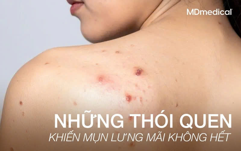 Thói quen khiến mụn lưng mãi không hết