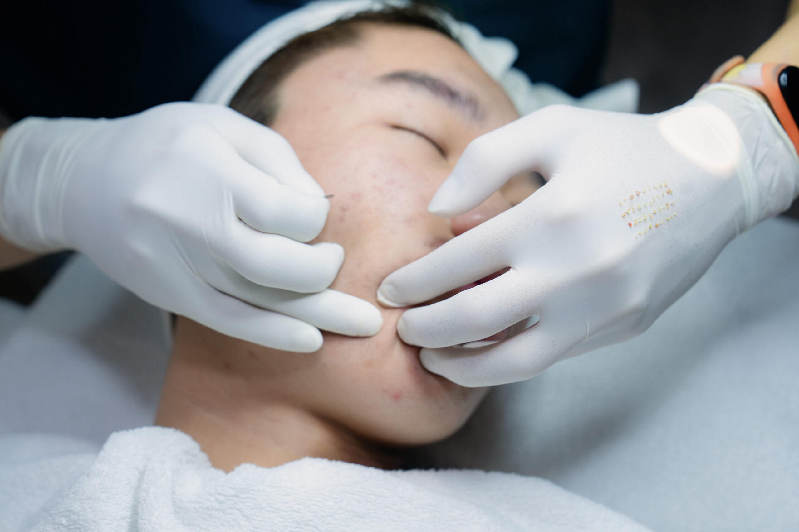 Điều trị mụn dậy thì tại MDmedical