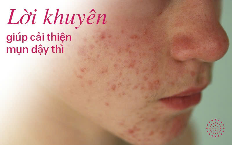 Những lời khuyên giúp cải thiện mụn tuổi dậy thì