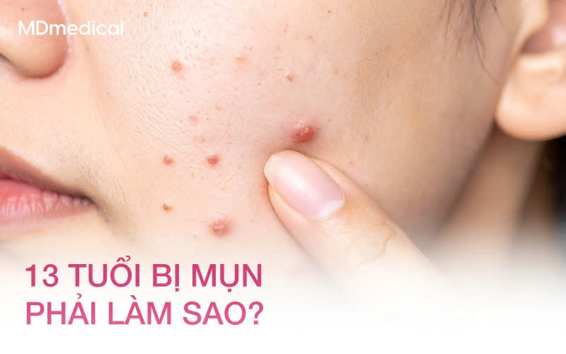 13 tuổi bị mụn phải làm sao? Hướng dẫn chăm sóc da đúng cách cho tuổi dậy thì
