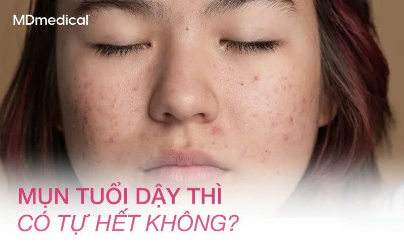 Mụn tuổi dậy thì có tự hết không