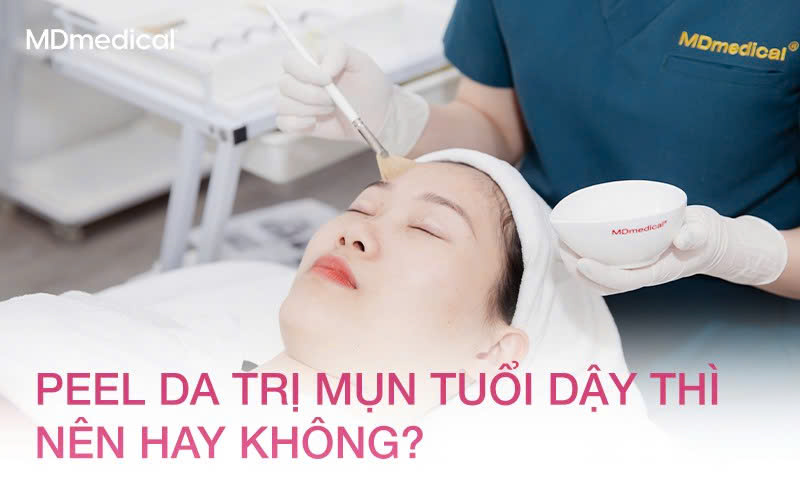 Peel da trị mụn dậy thì: Khi nào nên và không nên?