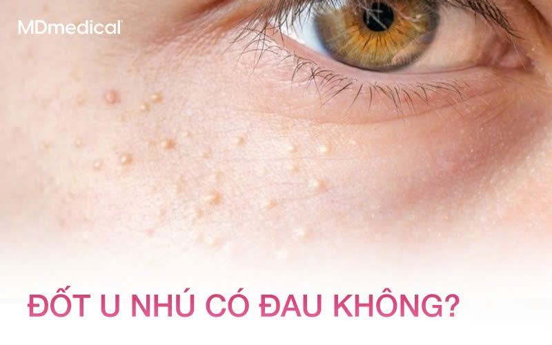 Đốt u nhú có đau không? Bao lâu thì lành?