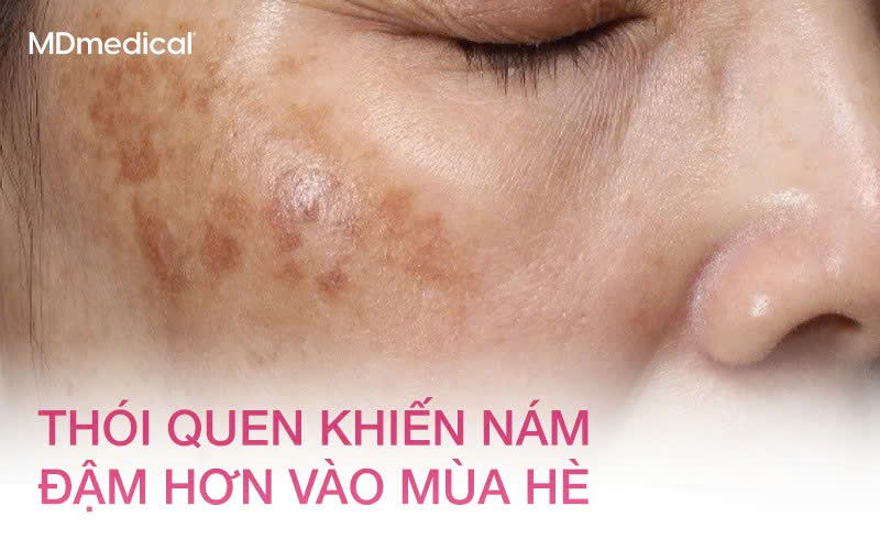 Những thói quen khiến nám tái phát nhanh hơn vào mùa hè