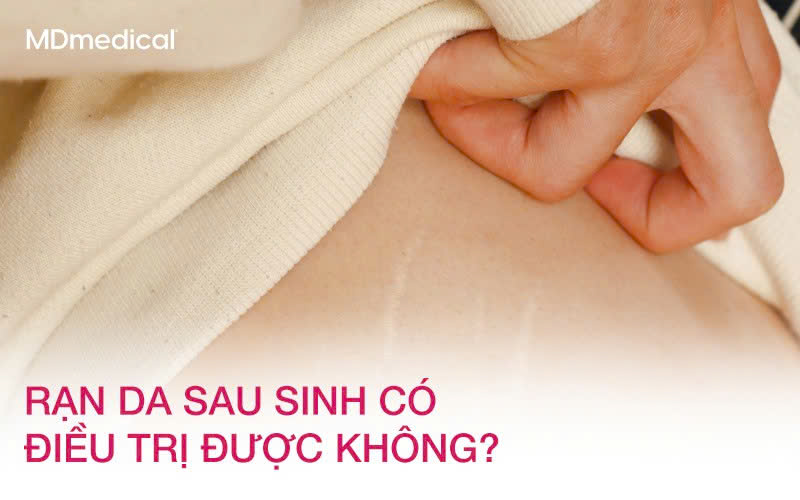 Rạn da sau sinh có điều trị được không? Giải đáp từ góc nhìn da liễu