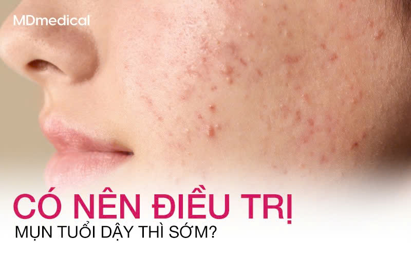 Có nên điều trị mụn dậy thì sớm? Góc nhìn dành cho phụ huynh