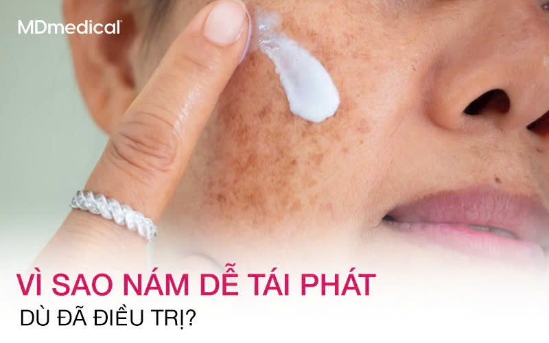 Vì sao nám dễ tái phát dù đã điều trị?