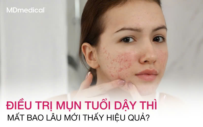 Điều trị mụn tuổi dậy thì mất bao lâu thì mới thấy hiệu quả