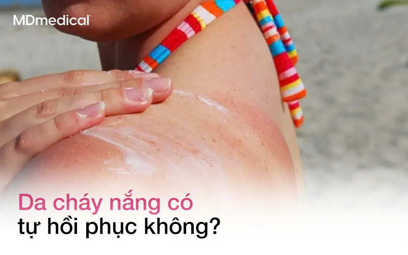 Da cháy nắng có tự hồi phục không?
