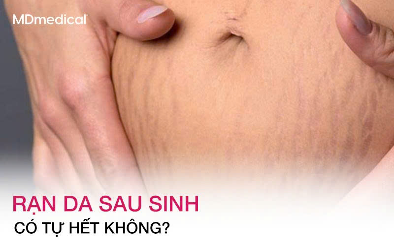 Rạn da sau sinh có tự hết không? Bao lâu thì mờ?