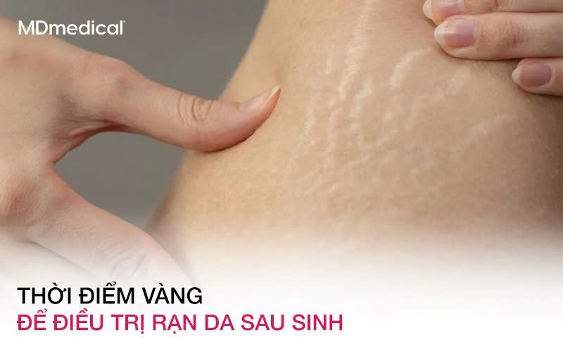 Thời điểm vàng để điều trị rạn da sau sinh