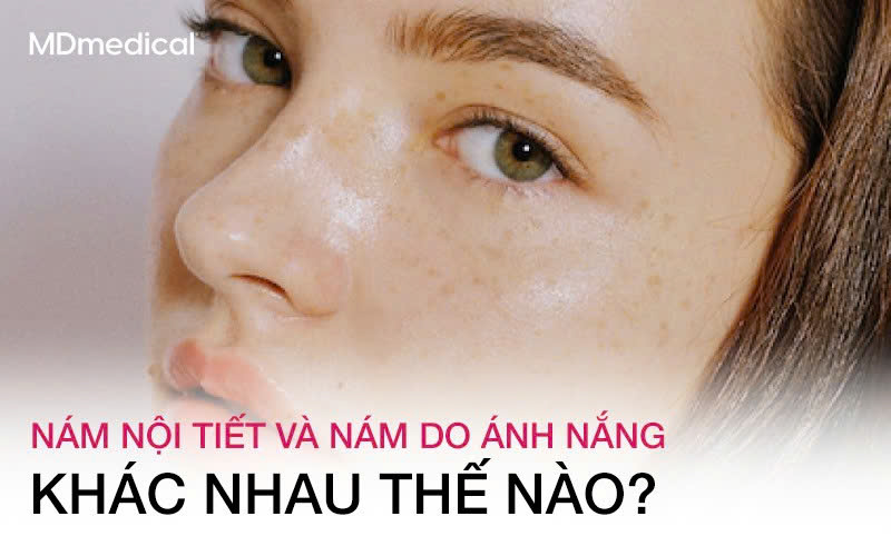 Nám nội tiết và nám do ánh nắng khác nhau thế nào?