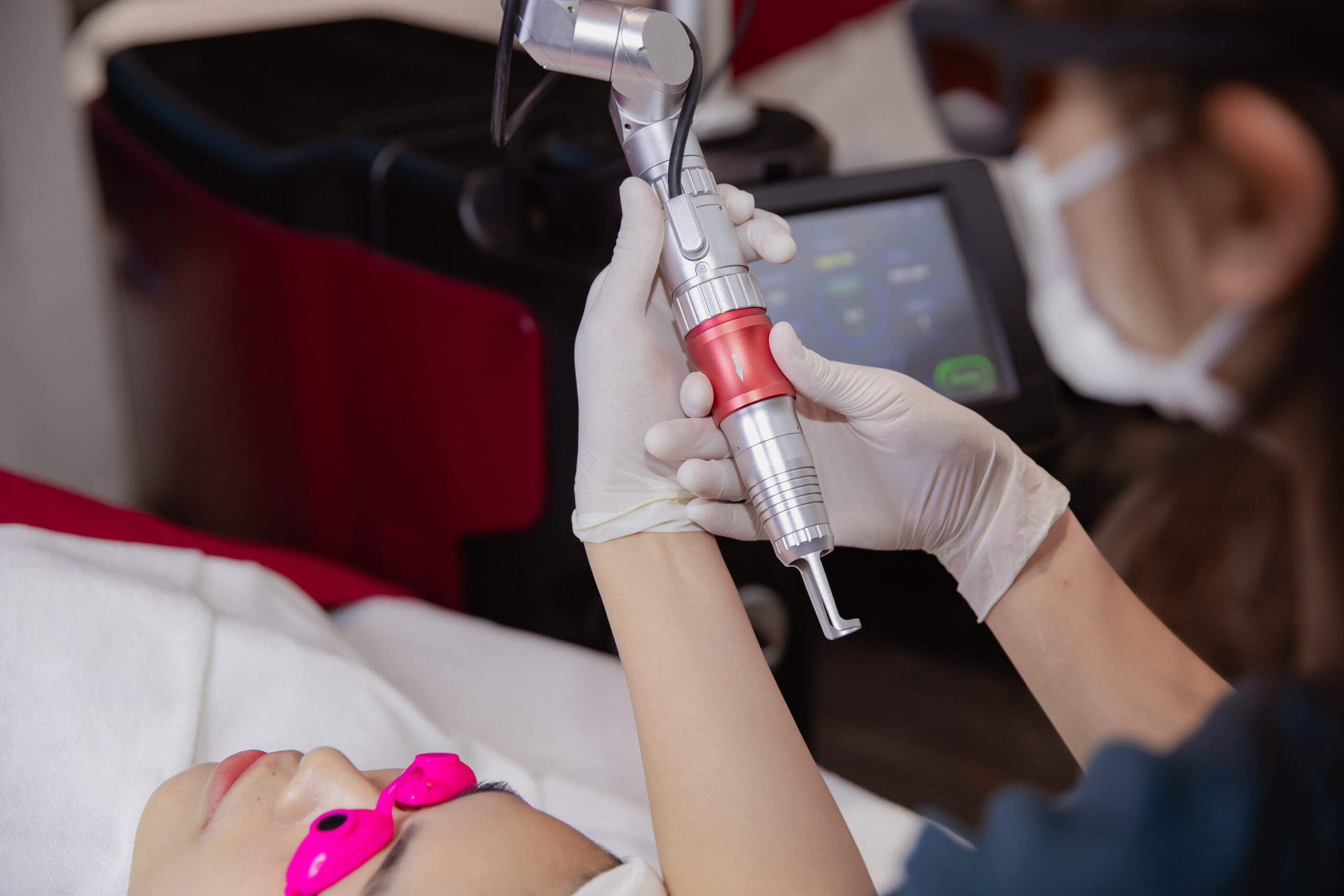 Điều trị rạn da sau sinh với công nghệ laser