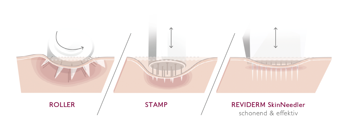 So sánh sự khác biệt giữa Skinneedle với các phương pháp truyền thống