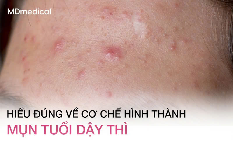 Hiểu đúng về cơ chế hình thành mụn tuổi dậy thì