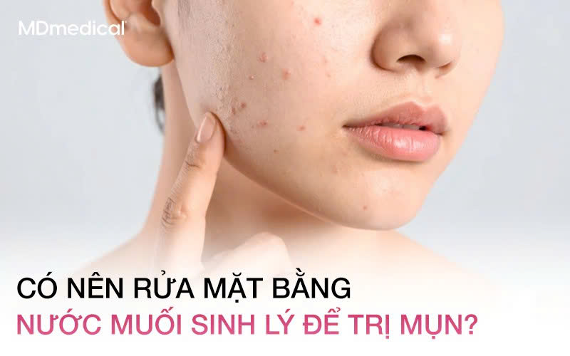 Có nên rửa mặt bằng nước muối sinh lý để trị mụn? Lời khuyên từ Bác sĩ da liễu