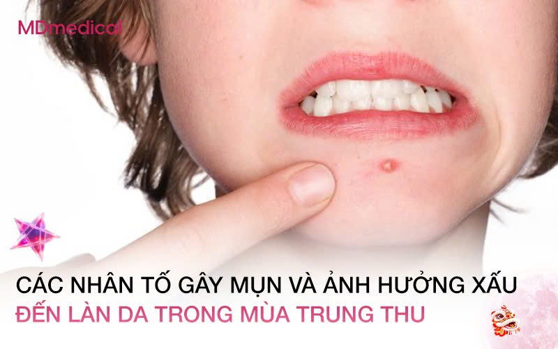 Các nhân tố gây mụn và ảnh hưởng xấu đến làn da trong mùa Trung Thu